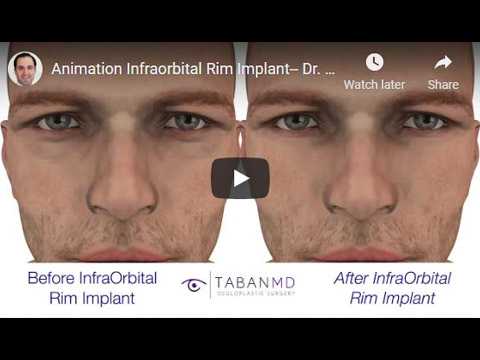 Animation Infraorbital Rim Implant click to see video