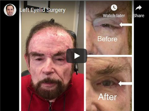 Left Eyelid Surgery click to see video