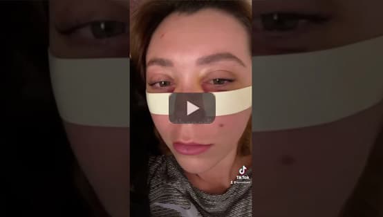 Lower Blepharoplasty Recovery Progress, Under Eye Bag Removal by Dr. Taban