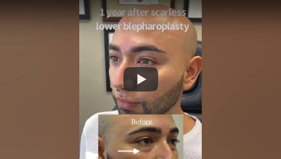 Scarless lower blepharoplasty