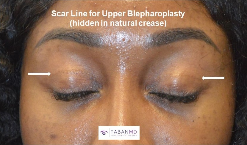 Scar Line for Upper Blepharoplasty (Hidden in natural crease)