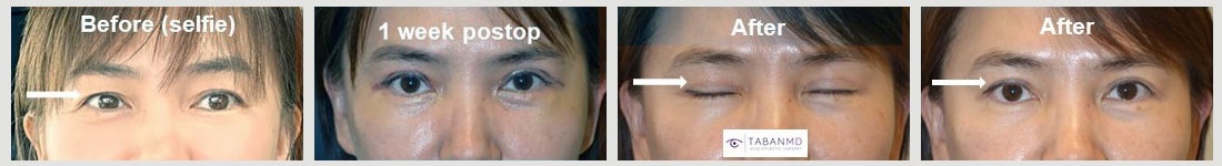 Middle age woman underwent customized Asian upper blepharoplasty (double eyelid surgery).