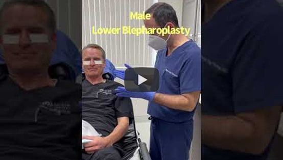 50+ year old ophthalmologist (Dr DeBry) with under eye fat bags, flew from Las Vegas to Los Angeles. He underwent lower blepharoplasty to improve under eye appearance. Note more youthful eye appearance.