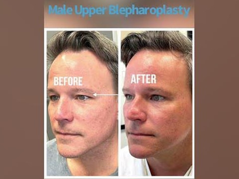 45 year old male with genetic and age related upper eyelid hooding underwent customized conservative male upper blepharoplasty.