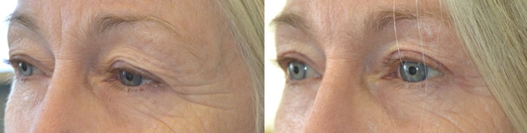 Before (left) and after (right) 68-year-old female, with saggy upper eyelids and brows, underwent cosmetic upper blepharoplasty and lateral pretrichial brow lift.
