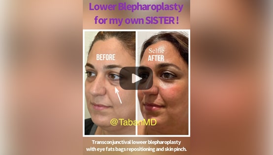 Dr. Taban performs Lower Blepharoplasty Surgery on his own sister!