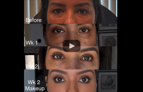 scarless lower blepharoplasty (with eye fat bags repositioning) and upper blepharoplasty