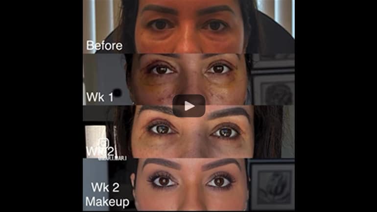 scarless lower blepharoplasty (with eye fat bags repositioning) and upper blepharoplasty